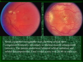 Axial computed tomography scan showing orbital apex
congestion bilaterally secondary to marked muscle enlargement
(arrows). The patient underwent bilateral orbital radiation and
orbital decompression. Final visual acuity was 20/40 in each eye.
 