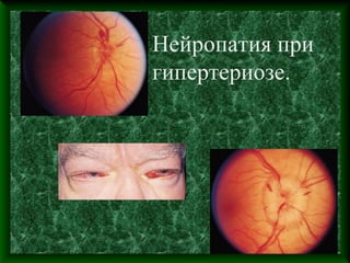 Нейропатия при
гипертериозе.
 