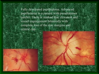 Fully developed papilledema. Advanced
papilledema in a patient with pseudotumor
cerebri. There is marked disc elevation and
vessel engorgement bilaterally with
complete loss of the disc margins and
central cup.
 