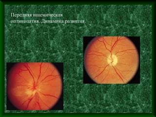 Передняя ишемическая
оптикопатия. Динамика развития.
 