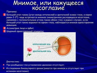 Мнимое, или кажущееся
Причины:
           косоглазие
Большой угол гамма (угол между оптической и зрительной осями глаза, в норме
равен 2-3°): чаще встречается мнимое симметричное расходящееся косоглазие,
связанное с положительным углом гамма обоих глаз; в редких случаях, если
большой угол гамма выражен на одном глазу, наблюдается мнимая односторонняя
девиация.
Ассиметрия лица и орбит;
Широкий односторонний эпикантус.




Диагностика :
При разобщении глаз установочное движение отсутствует;
Исследование бинокулярного зрения (имеется при мнимом и отсутствует при
истинном косоглазии).
 