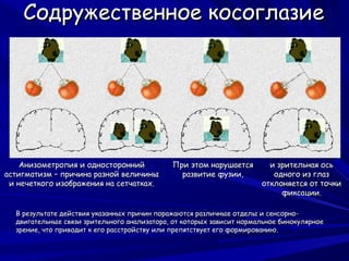 Содружественное косоглазие




    Анизометропия и односторонний            При этом нарушается        и зрительная ось
астигматизм – причина разной величины          развитие фузии,           одного из глаз
 и нечеткого изображения на сетчатках.                                отклоняется от точки
                                                                           фиксации.

  В результате действия указанных причин поражаются различные отделы и сенсорно-
  двигательные связи зрительного анализатора, от которых зависит нормальное бинокулярное
  зрение, что приводит к его расстройству или препятствует его формированию.
 