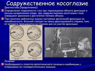 Содружественное косоглазие
Диагностика (продолжение):
Определение подвижности глаз при перемещении объекта фиксации в
восьми направлениях взора: при содружественном косоглазии глаза
совершают движения в достаточно полном объеме.
При наличии амблиопии оценка состояния зрительной фиксации на
монобиноскопе: больной смотрит на конец фиксационного стержня, тень
от которого проецируется на глазном дне на участок фиксации.




Лечение:
Необходимость плеопто-ортоптического лечения в комбинации с
операциями на глазодвигательных мышцах.
 