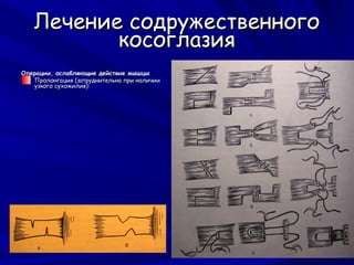 Лечение содружественного
          косоглазия
Операции, ослабляющие действие мышцы
   Пролонгация (затруднительна при наличии
   узкого сухожилия):




    Частичная тенотомия
 