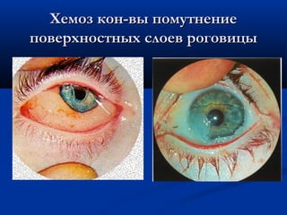 Хемоз кон-вы помутнение
поверхностных слоев роговицы
 