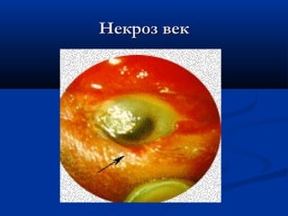 Некроз век
 