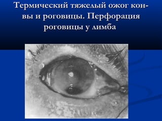 Термический тяжелый ожог кон-
  вы и роговицы. Перфорация
       роговицы у лимба
 