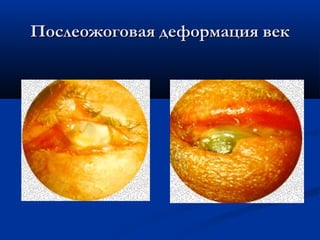 Послеожоговая деформация век
 