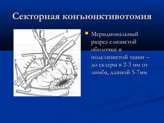 Секторная конъюнктивотомия
                Меридиональный
                 разрез слизистой
                 оболочки и
                 подслизистой ткани –
                 до склеры в 2-3 мм от
                 лимба, длиной 5-7мм
 