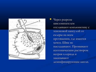    Через разрезы
    циклошпателем
    отслаивают конъюнктиву с
    теноновой капсулой от
    склеры на всем
    протяжении, где имеется
    хемоз. Швы не
    накладывают. Промывают
    изотоническим раствором
    натрия хлорида и
    закапывают
    дезинфицирующие капли.
 