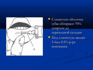    Слизистую оболочку
    губы обтирают 70%
    спиртом до
    переходной складки
   Под слизистую вводят
    5-6мл 0.5% р-ра
    новокаина
 