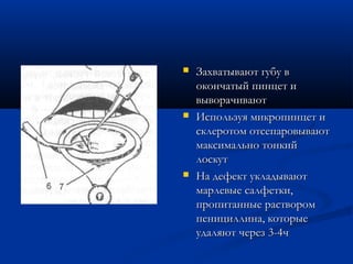    Захватывают губу в
    окончатый пинцет и
    выворачивают
   Используя микропинцет и
    склеротом отсепаровывают
    максимально тонкий
    лоскут
   На дефект укладывают
    марлевые салфетки,
    пропитанные раствором
    пенициллина, которые
    удаляют через 3-4ч
 