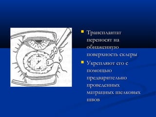    Трансплантат
    переносят на
    обнаженную
    поверхность склеры
   Укрепляют его с
    помощью
    предварительно
    проведенных
    матрацных шелковых
    швов
 