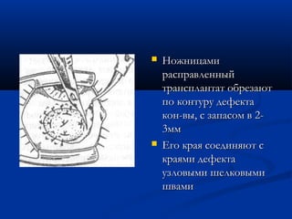    Ножницами
    расправленный
    трансплантат обрезают
    по контуру дефекта
    кон-вы, с запасом в 2-
    3мм
   Его края соединяют с
    краями дефекта
    узловыми шелковыми
    швами
 