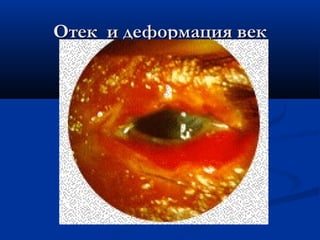 Отек и деформация век
 