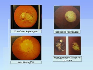 Колобома хориоидеи    Колобома хориоидеи




                     Псевдоколобома желто-
                            го пятна
  Колобома ДЗН
 