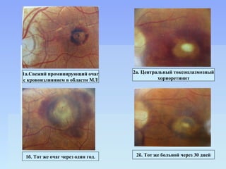 1а.Свежий проминирующий очаг       2а. Центральный токсоплазмозный
с кровоизлиянием в области МЛ                хориоретинит




 1б. Тот же очаг через один год.    2б. Тот же больной через 30 дней
 