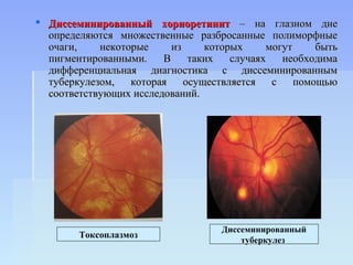  Диссеминированный хориоретинит – на глазном дне
  определяются множественные разбросанные полиморфные
  очаги,    некоторые     из     которых     могут     быть
  пигментированными.    В     таких   случаях   необходима
  дифференциальная диагностика с диссеминированным
  туберкулезом,   которая    осуществляется   с    помощью
  соответствующих исследований.




                                    Диссеминированный
        Токсоплазмоз
                                        туберкулез
 