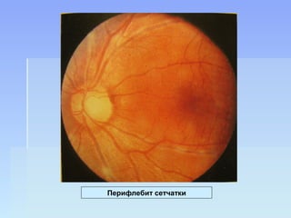 Перифлебит сетчатки
 