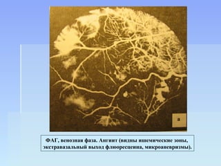 ФАГ, венозная фаза. Ангиит (видны ишемические зоны,
экстравазальный выход флюоресцеина, микроаневризмы).
 