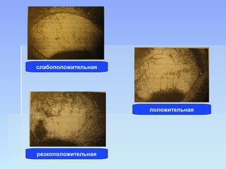 слабоположительная




                     положительная




резкоположительная
 