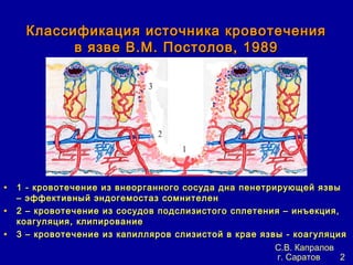 Классификация источника кровотечения
           в язве В.М. Постолов, 1989




• 1 - кровотечение из внеорганного сосуда дна пенетрирующей язвы
    – эффективный эндогемостаз сомнителен
•   2 – кровотечение из сосудов подслизистого сплетения – инъекция,
    коагуляция, клипирование
•   3 – кровотечение из капилляров слизистой в крае язвы - коагуляция
                                                       С.В. Капралов
                                                       г. Саратов    2
 