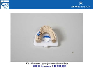 K1 - Giroform upper jaw model complete
      完整的 Giroform 上顎石膏模型
 