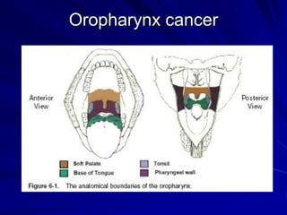 Oropharynx cancer
 