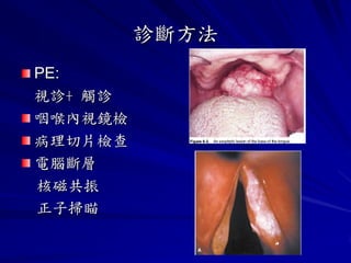 診斷方法
PE:
視診+ 觸診
咽喉內視鏡檢
病理切片檢查
電腦斷層
核磁共振
正子掃瞄
 