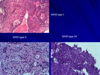 WHO type I




WHO type II           WHO type IIII
 