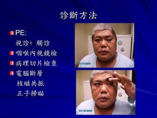 診斷方法
PE:
視診+ 觸診
咽喉內視鏡檢
病理切片檢查
電腦斷層
核磁共振
正子掃瞄
 