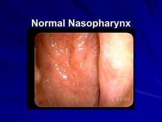 Normal Nasopharynx
 