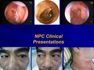 NPC Clinical
Presentations
 