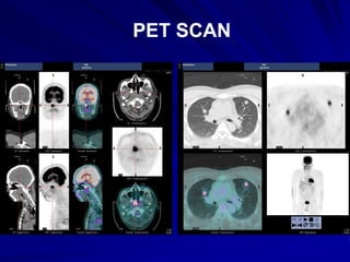 PET SCAN
 