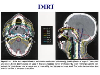 IMRT
 