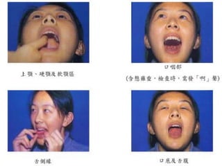 頭頸部癌症之治療 簡志彥