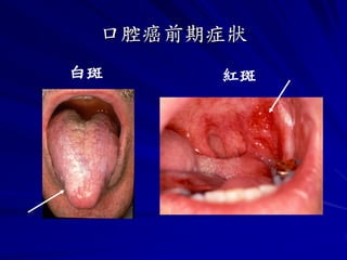 口腔癌前期症狀
白斑    紅斑
 