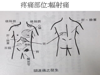 疼痛部位:幅射痛
 