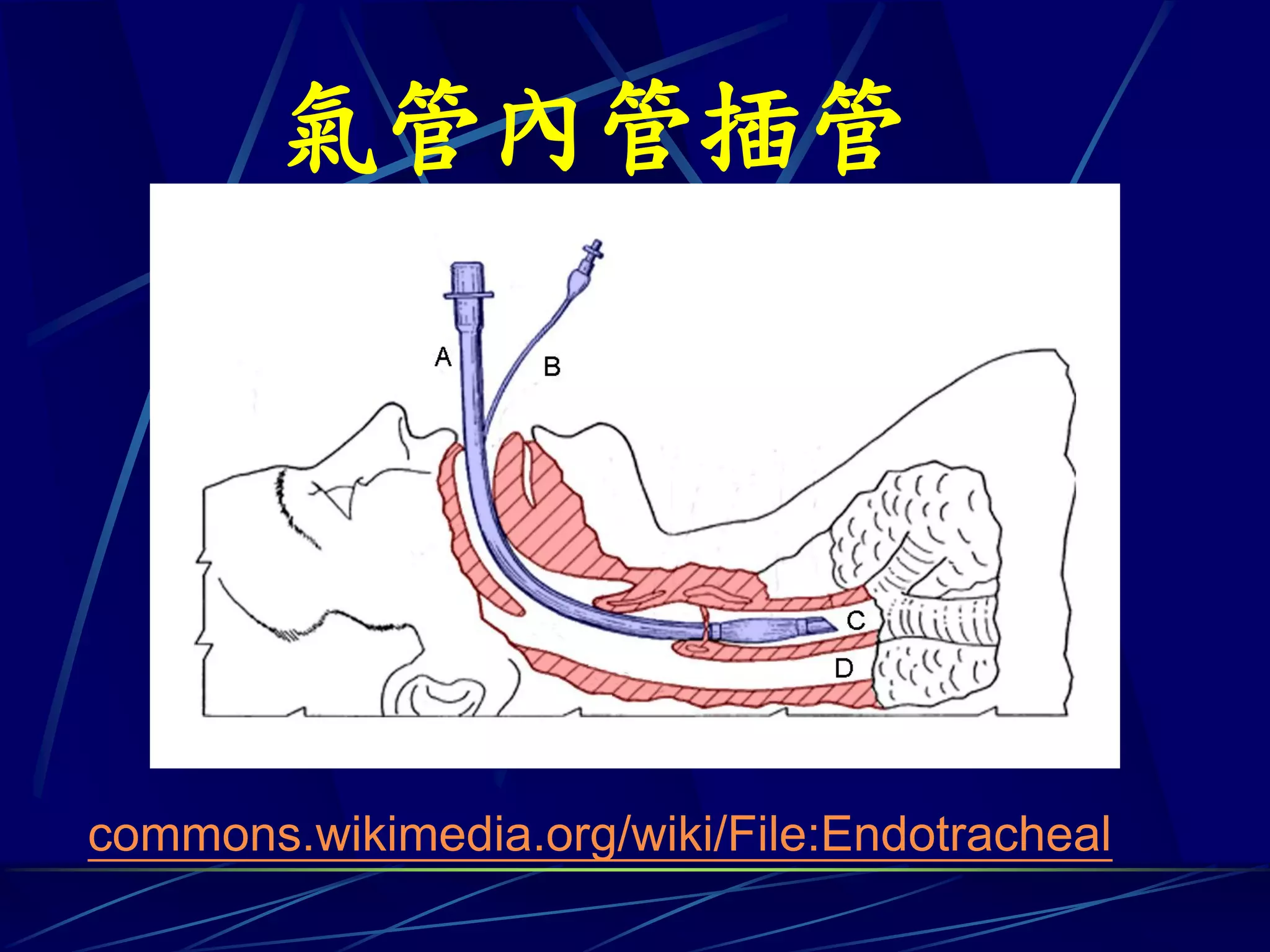 氣管內管插管




commons.wikimedia.org/wiki/File:Endotracheal
 
