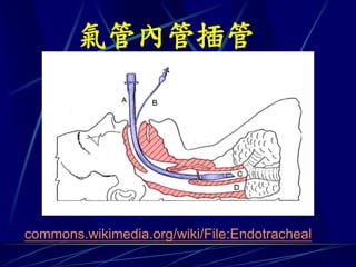 氣管內管插管




commons.wikimedia.org/wiki/File:Endotracheal
 
