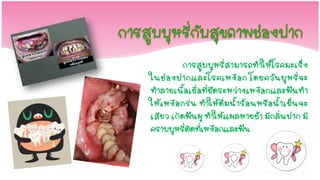 การสูบบุหรี่สามารถทาให้โ รคมะเร็ง
ในช่ อ งปากและโรคเหงื อ ก โดยควั น บุ ห รี่ จ ะ
ทาลายเนื้อเยื่อที่ยึดระหว่างเหงือกและฟันทา
ให้ เ หงื อ กร่ น ท าให้ ดื่ ม น้ าร้ อ นหรื อ น้ าเย็ น จะ
เสียว เกิดฟันผุ ทาให้แผลหายช้า มีกลิ่นปาก มี
คราบบุหรี่ติดที่เหงือกและฟัน
 