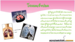 ผู้ ที่ สู บุ ห รี่ ที่ มี ไ ส้ ก รองจะ มี
อุ บั ติ ก า ร ณ์ ข อ ง ม ะ เ ร็ ง ป อ ด ช นิ ด
adenocarcinoma สูงเนื่องจากผู้ป่วยจะสูด
เข้ า แรงมากท าให้ ส ารก่ อ มะเร็ ง เข้ า สู่
ปอด ผู้ที่สูบบุหรี่ที่ใส่ menthol ก็มีโอกาส
เป็นมะเร็งปอดสูง นอกจากมะเร็งปอด
แล้ ว บุหรี่ ยังก่ อให้ เ กิ ด มะเร็งที่ คอ ปาก
หลอดอาหาร ไตกระเพาะปัสสาวะ มดลูก
 