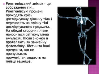  Рентгенівський знімок – це
 зображення тіні.
 Рентгенівські промені
 проходять крізь
 досліджувану ділянку тіла і
 переносять на плівку тіні
 досліджуваного предмета.
 На обидві сторони плівки
 наноситься світлочутлива
 емульсія. Після зйомки її
 проявляють як звичайну
 фотоплівку. Кістки та інші
 предмети, що не
 пропускають
 промені, виглядають на
 плівці темніше.
 