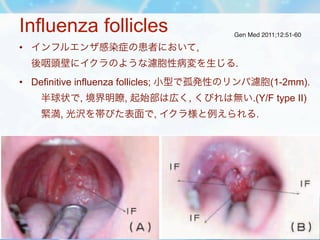 Influenza follicles                                       Gen Med 2011;12:51-60

     • インフルエンザ感染症の患者において,
         後咽頭壁にイ...