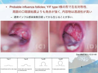 • Probable influenza follicles; Y/F type I様の形で左右対称性.
         周囲の口咽頭粘膜よりも発赤が強く, 内容物は透過性が高い
         – 通常インフル感染後数日経ってから生じるこ...