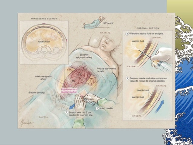 腹水検査 講義用