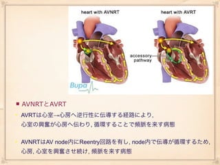    AVNRTとAVRT
• AVRTは心室→心房へ逆行性に伝導する経路により,
    心室の興奮が心房へ伝わり, 循環することで頻脈を来す病態


• AVNRTはAV node内にReentry回路を有し, node内で伝導が循環するため,
    心房, 心室を興奮させ続け, 頻脈を来す病態
 