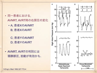 • 同一患者における,
    AVNRT, AVRT時の右房圧の変化
     • A; 患者XのAVNRT
        B; 患者XのAVRT

        C; 患者YのAVNRT
        D; 患者YのAVRT


 • AVNRT, AVRTの判別には
    頚静脈圧, 拍動が有効かも.



N Engl J Med 1992;327:772-4
 