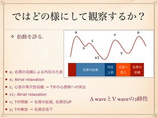 ではどの様にして観察するか？
                             a                                a
                                                   v
        拍動を診る.
                                     c
                                 x
                                                       y
                                         x1

                                              内圧       右室へ   右房の
                                 右房の拡張
   a; 右房の収縮による内圧の亢進                          上昇       流入    収縮

   x; Atrial relaxation 
   c; 心室の等尺性収縮 → T弁の心房側への突出
   x1; Atrial relaxation 
   v; T弁閉鎖 → 右房の拡張, 右房圧UP
                                     A waveとV waveの2峰性
   y; T弁解放 → 右房圧低下
 