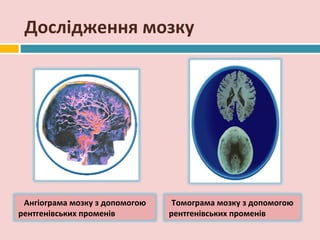 Дослідження мозку




 Ангіограма мозку з допомогою    Томограма мозку з допомогою
рентгенівських променів         рентгенівських променів
 
